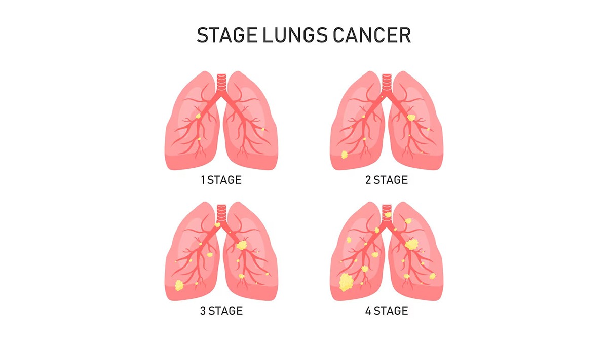 understanding-cancer-stages-stage-1-to-stage-4